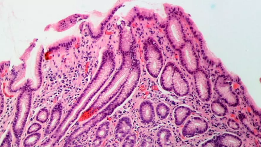 Helicobacter pylori: jedná se o příznaky infekce, která postihuje polovinu populace.